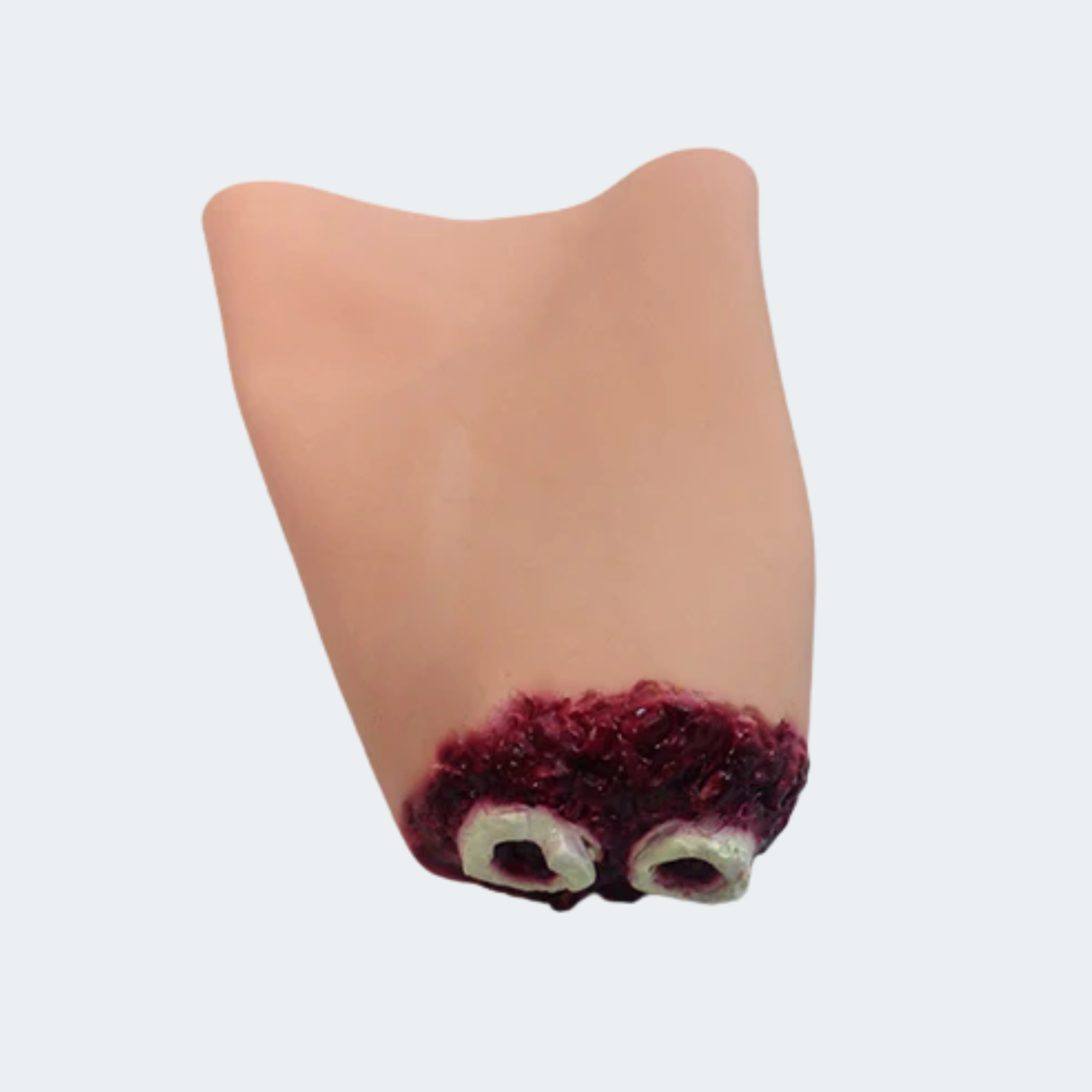 Hand Amputation
