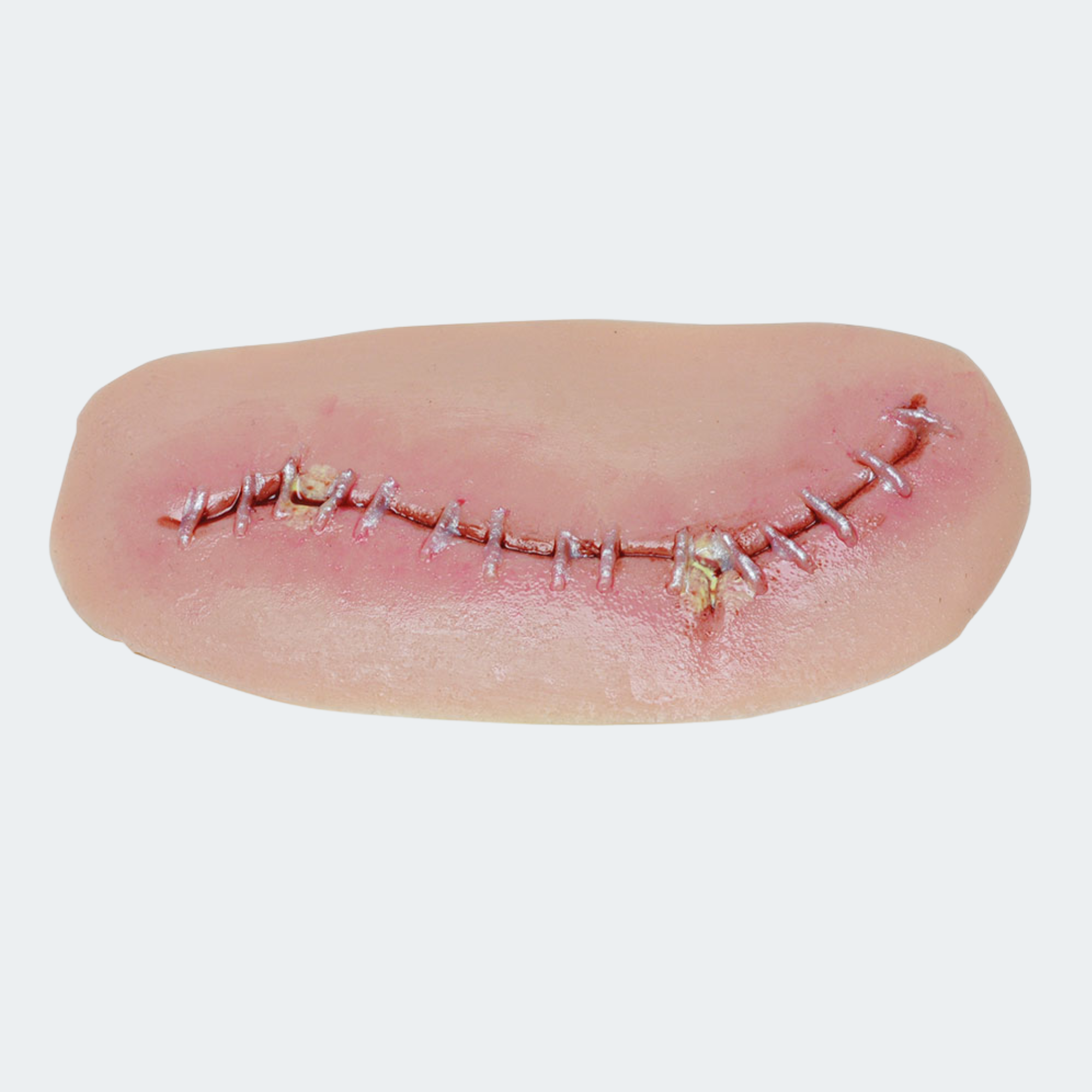 Level 1 Surgical Site Infection