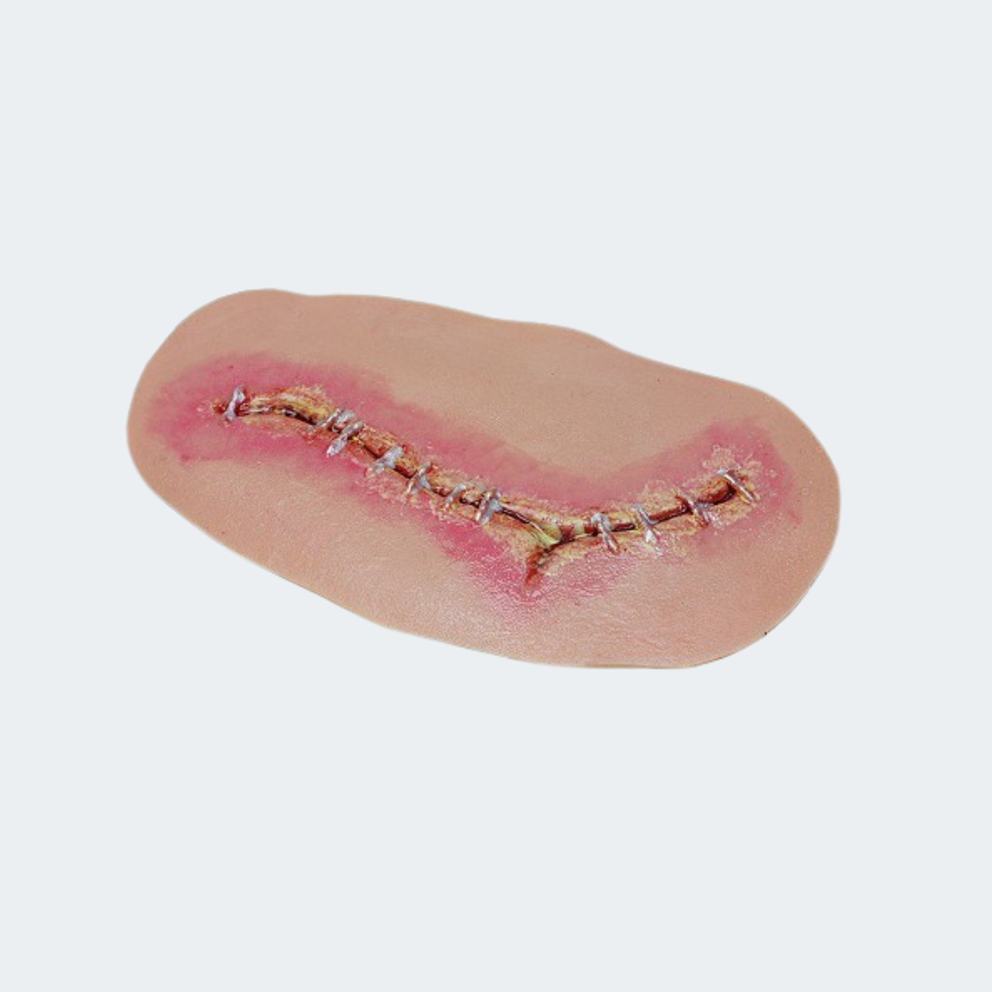 Level 2 Surgical Site Infection