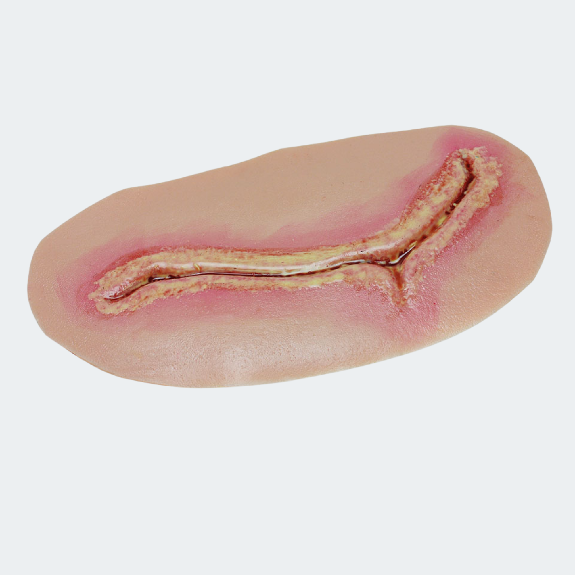 Level 3 Surgical Site Infection