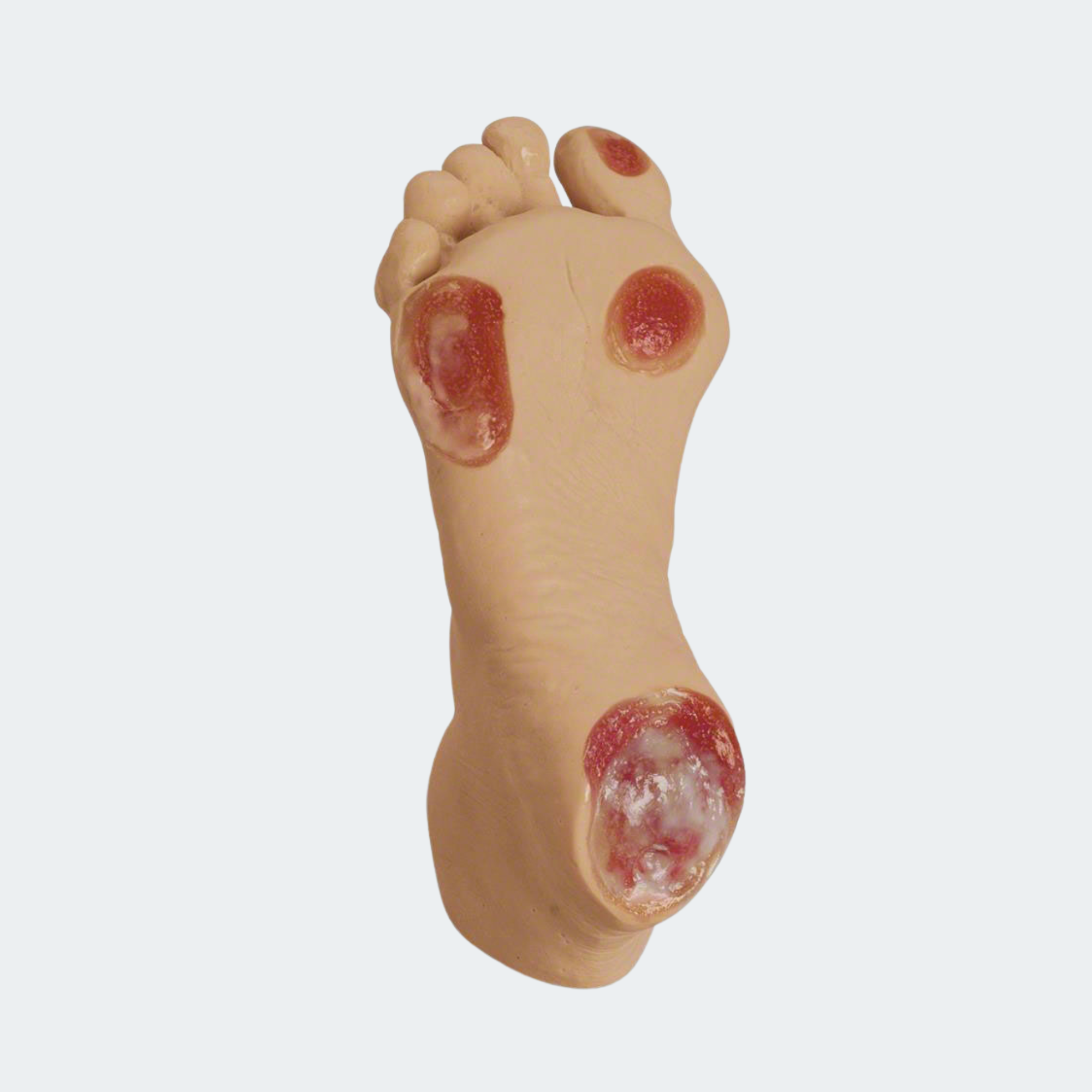 Life/form Elderly Pressure Ulcer Foot Part #: LF00933U