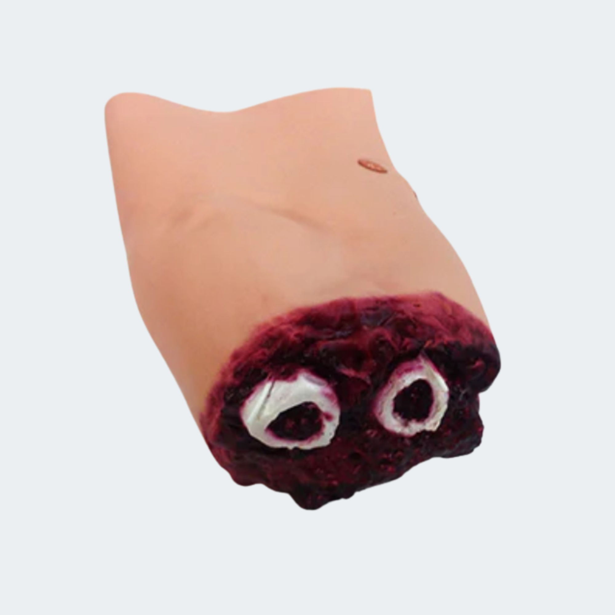 Lower Arm Amputation