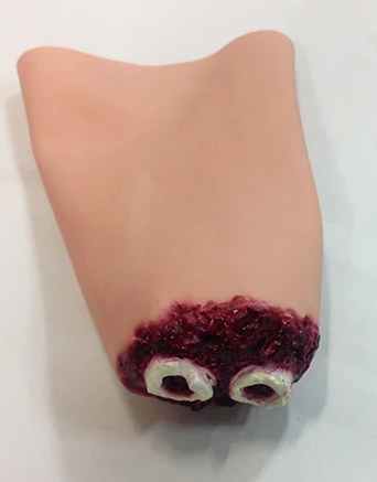 Hand Amputation