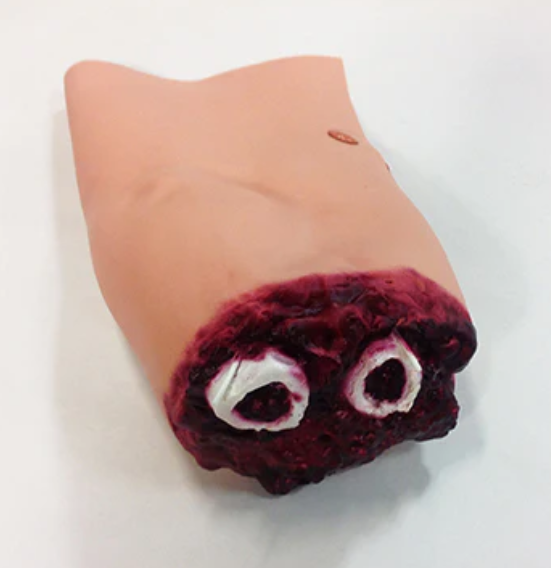 Lower Arm Amputation